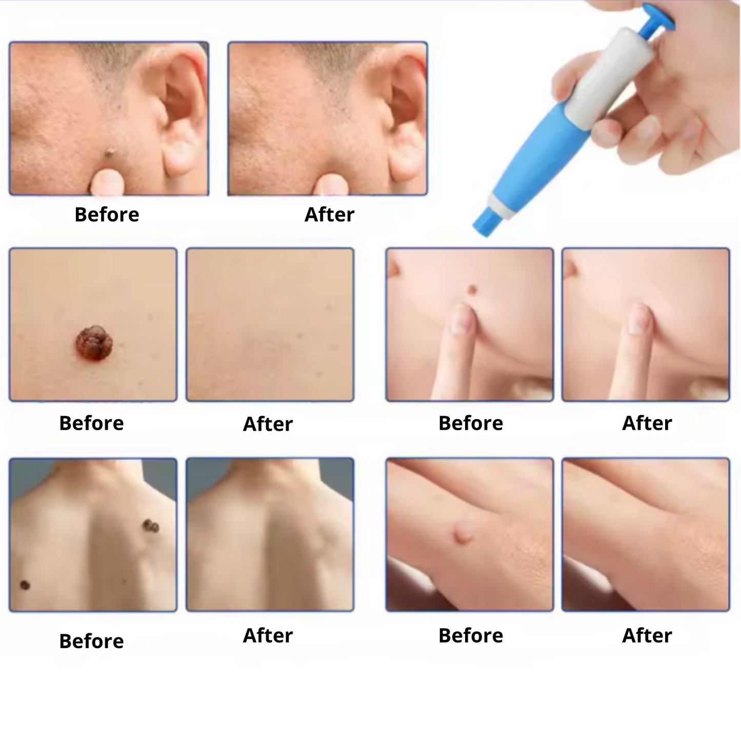 Lush TagPen Kit™ | Remove skin tags easily at home