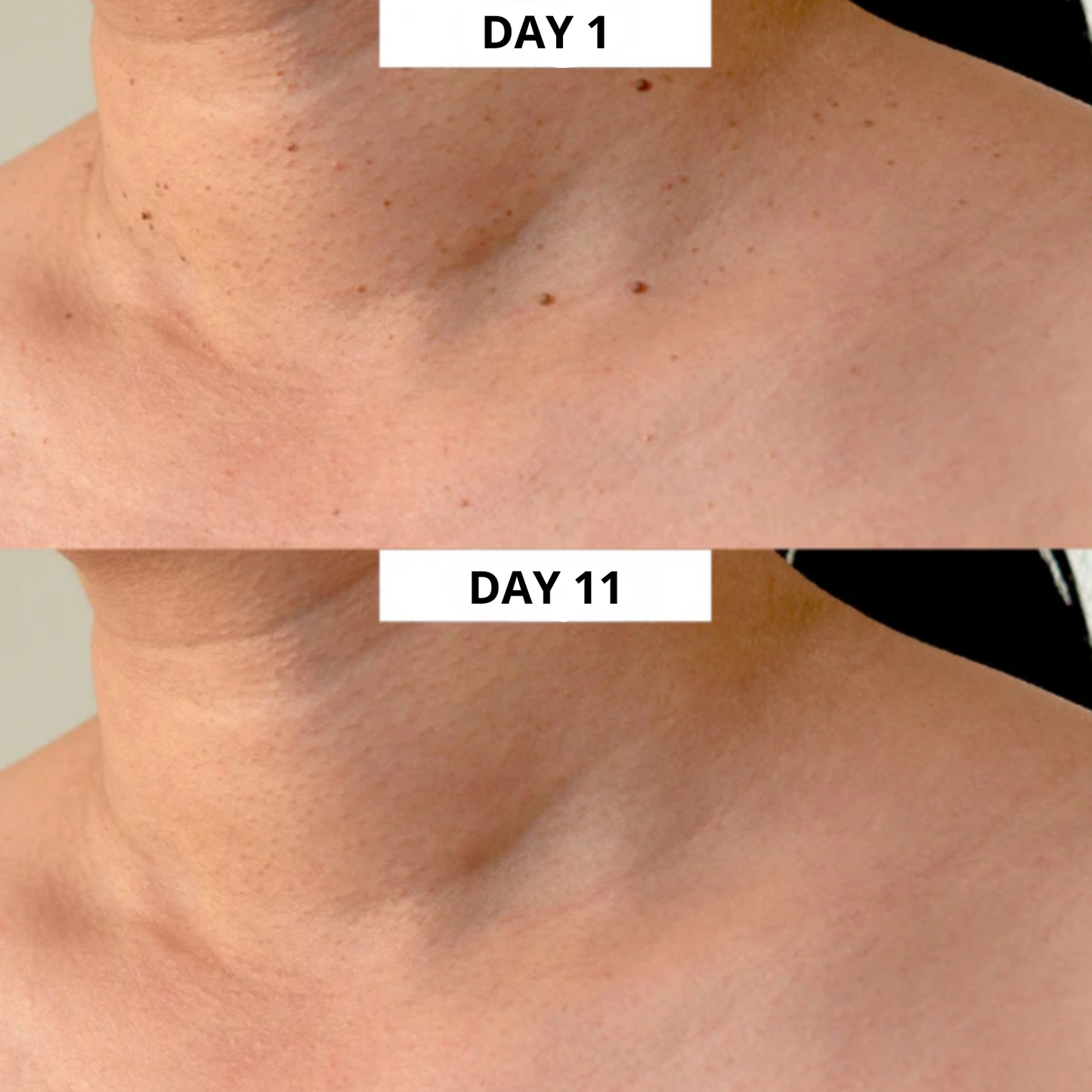 Lush TagPen Kit™ | Remove skin tags easily at home