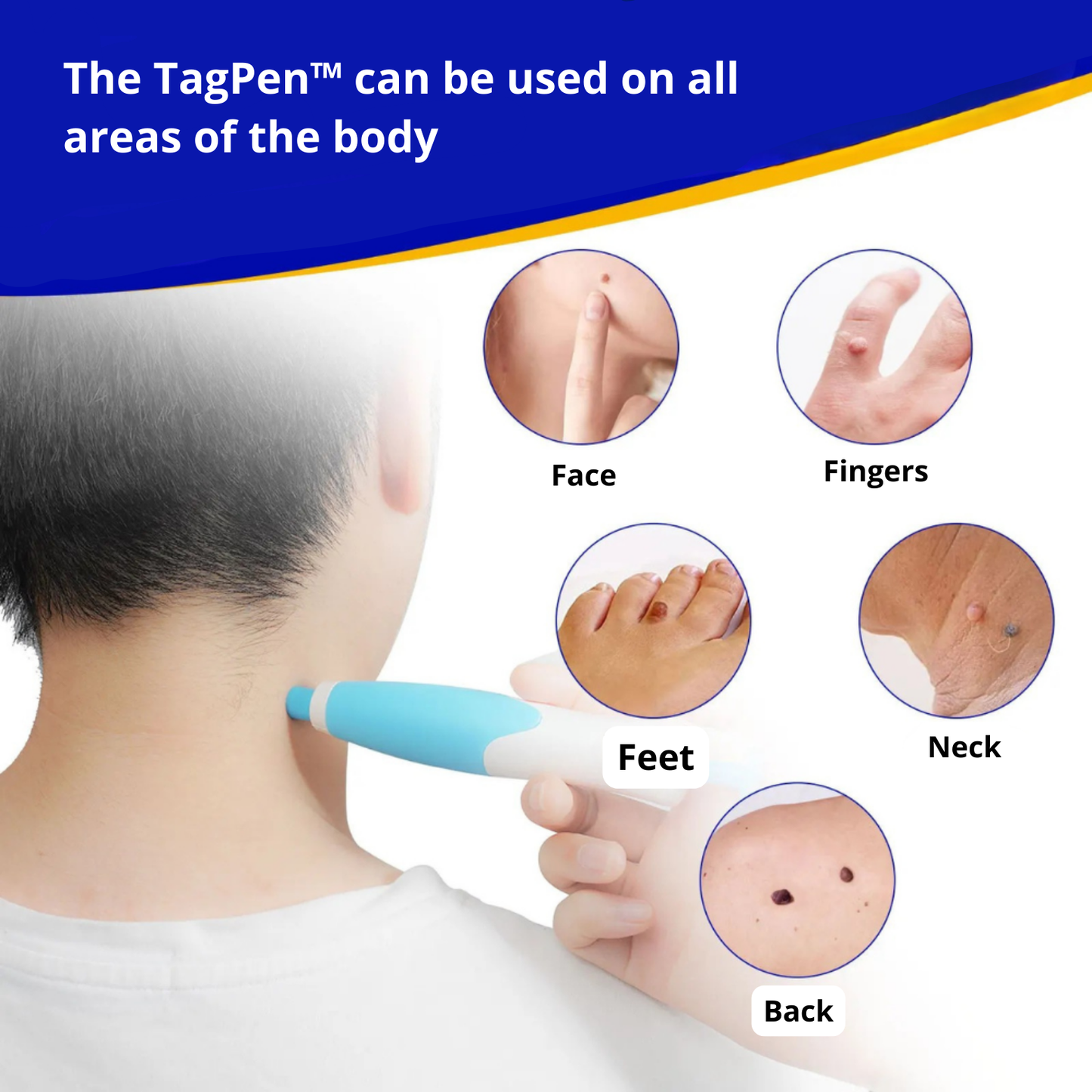 Lush TagPen Kit™ | Remove skin tags easily at home