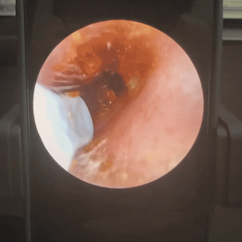 Lushy Tür | Vom Arzt empfohlene Technologie für die Ohrengesundheit