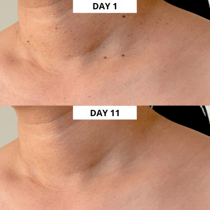 Lush TagPen Kit™  | Remove skin tags easily at home