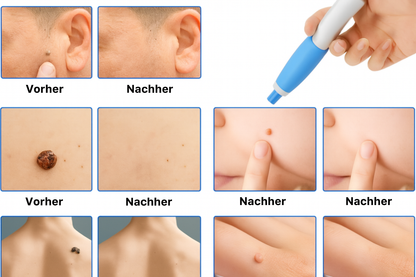 Lush TagPen Kit™ | Hautanhängsel einfach zu Hause entfernen